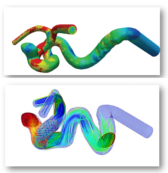 Simulation 3D et parallèle de l'écoulement sanguin dans un anévrysme traité par un stent. © Elie Hachem