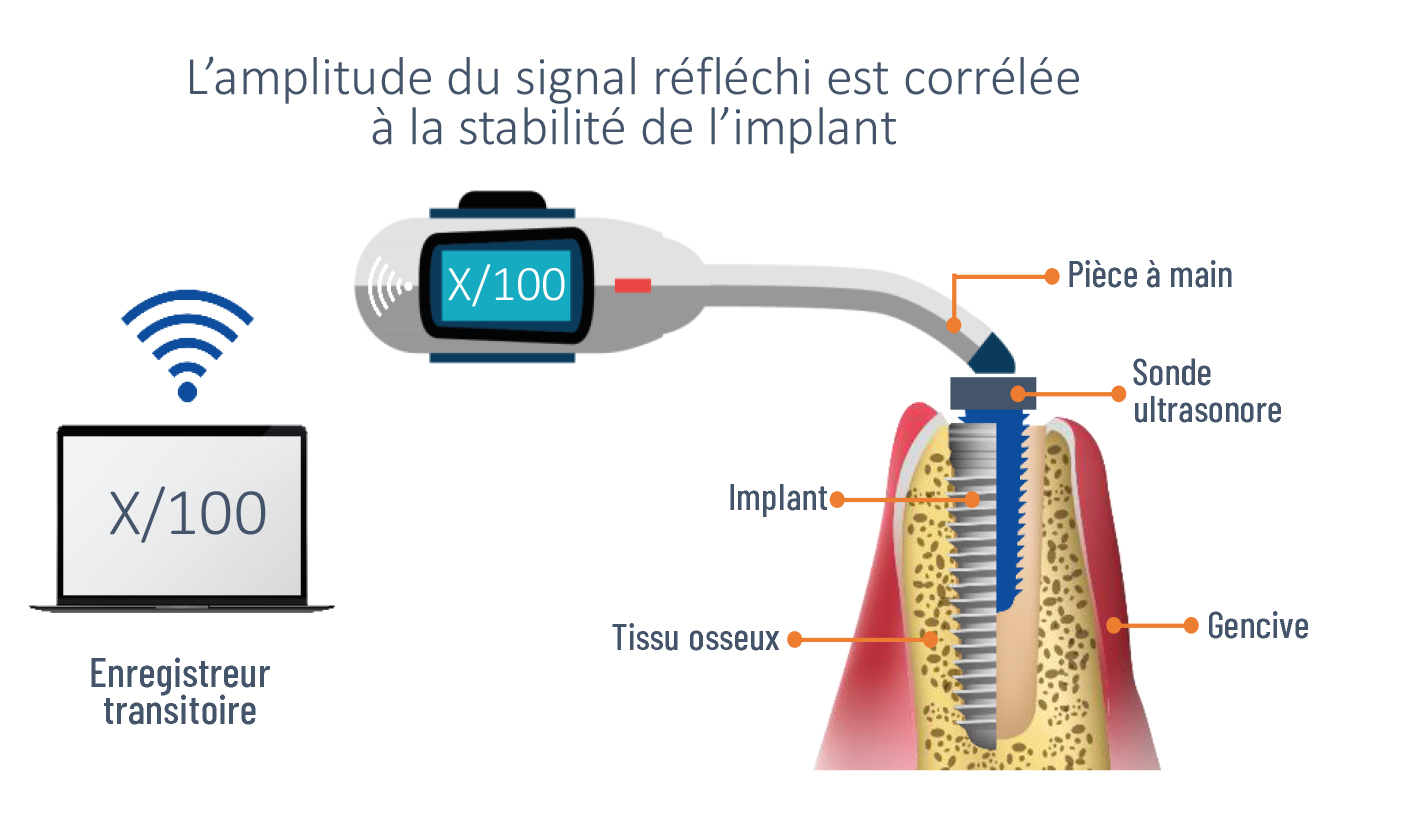 Porjet OsseoWave