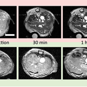 Des nanoparticules furtives pour l’imagerie par résonance magnétique